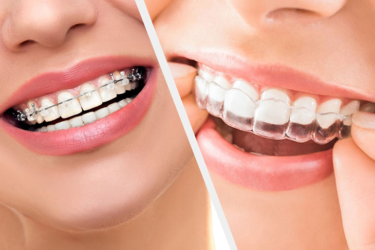 Advantages of Aligners over Traditional Braces